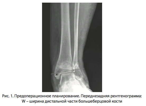 Рис. 1. Предоперационное планирование