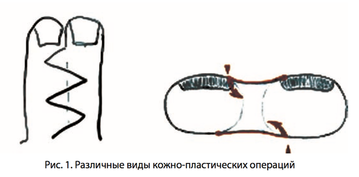 Рис. 1. Различные виды кожно-пластических операций