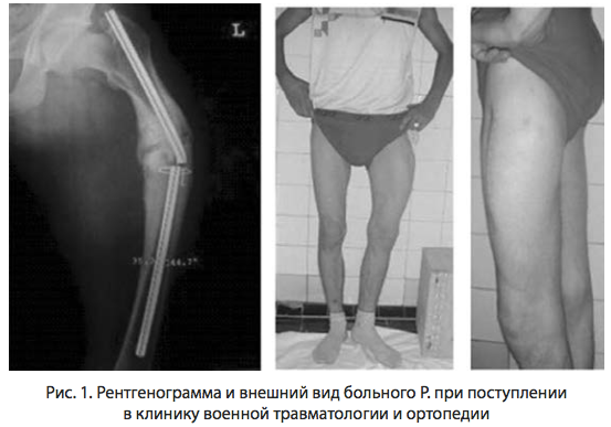 Рис. 1. Рентгенограмма и внешний вид больного Р