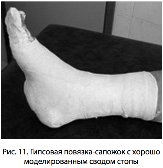 Рис. 11. Гипсовая повязка-сапожок