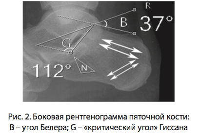 Рис. 2. Боковая рентгенограмма пяточной кости