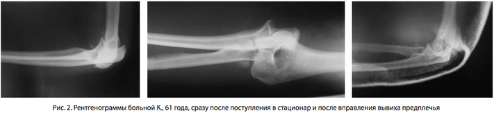 Рис. 2. Рентгенограммы больной К