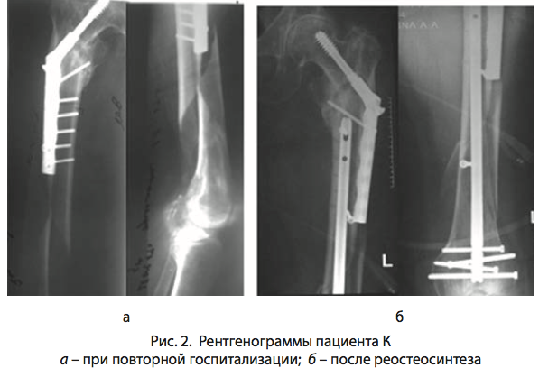 Чрезвертельный перелом остеосинтез. Сросшийся перелом бедренной кости рентген. Остеосинтез перелома бедра.