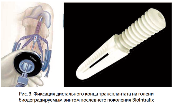 Рис. 3. Фиксация дистального конца