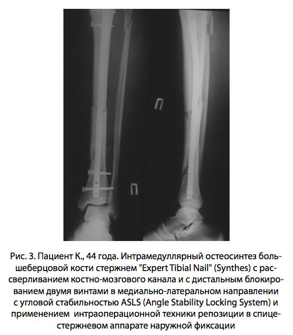Рис. 3. Пациент К., 44 года. Интрамедуллярный остеосинтез