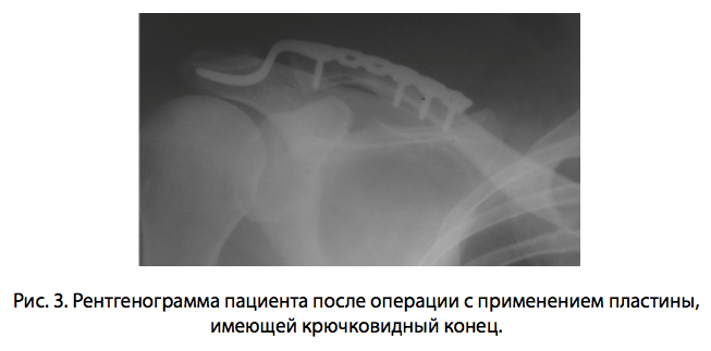 Рис. 3. Рентгенограмма