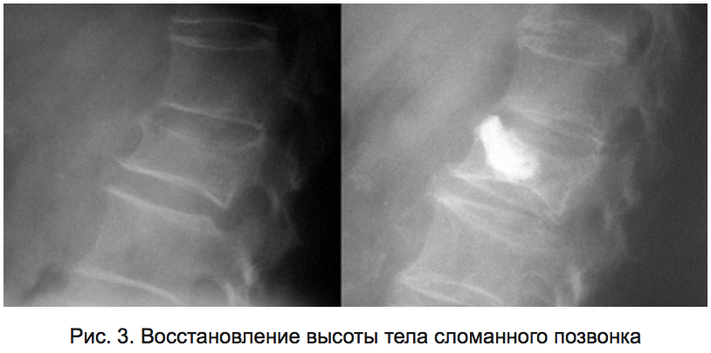 Рис. 3. Восстановление высоты тела