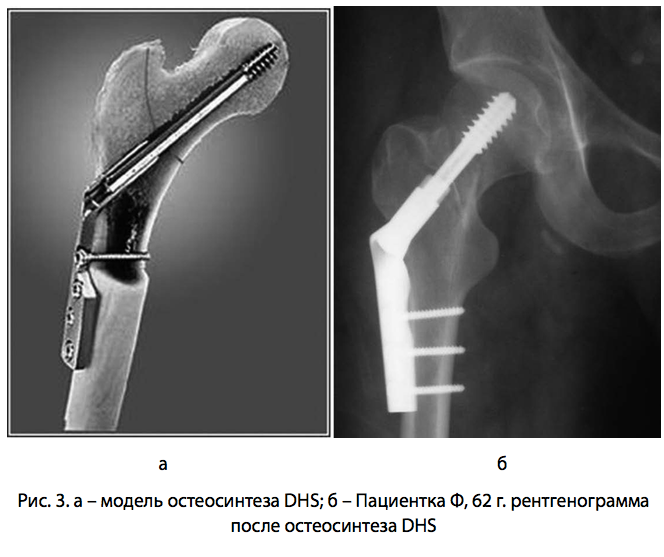 Рис. 3.модель рентген