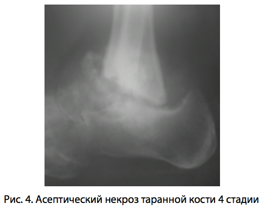 Асептический таранной кости. Асептический некроз таранная кость. Асептический некроз пяточной кости рентген. Остеонекроз таранной кости кт. Асептический некроз стопы рентген.