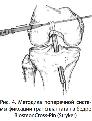 Рис. 4. Методика поперечной системы фиксации