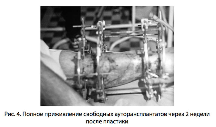 Рис. 4. Полное приживление свободных ауторансплантатов