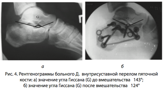 Рис. 4. Рентгенограммы больного Д