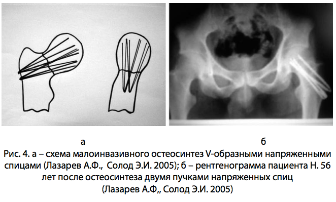 Рис. 4.схема рентген