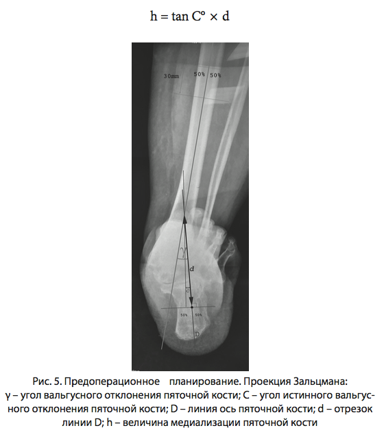 Рис. 5. Предоперационное зальцман
