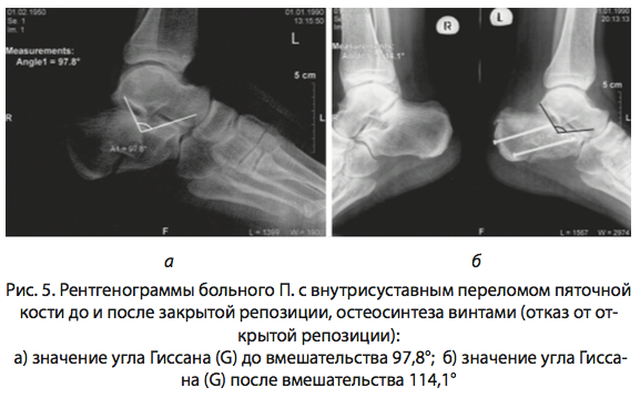 Перелом пяточной кости со смещением операция. Пяточная кость перелом на рентгене. Рентгенография перелома пяточной кости. Перелом пяточной кости рентген классификация. Перелом пяточной кости рентген протокол.