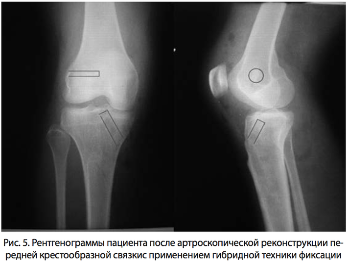 Рис. 5. Рентгенограммы пациента после